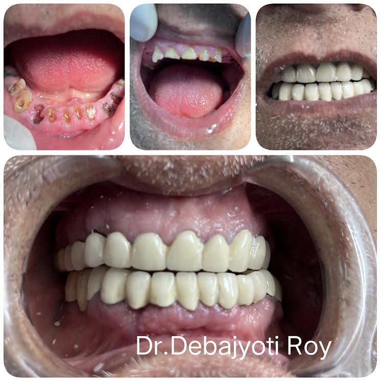 Complex Full-Mouth Rehabilitation