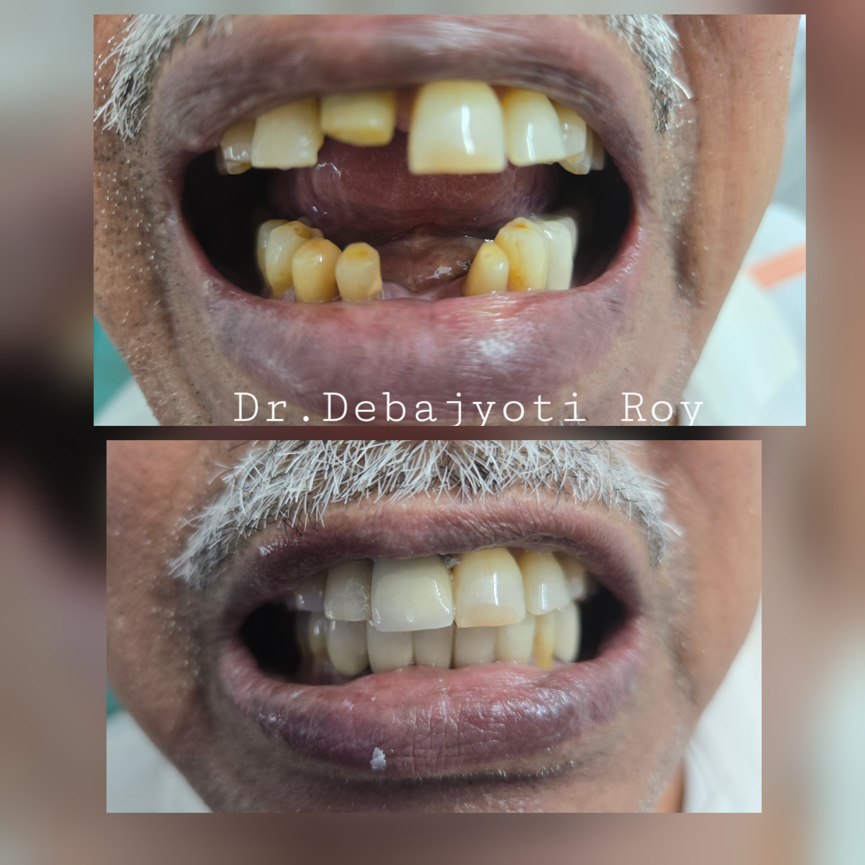 Geriatric Prosthodontic Intervention
