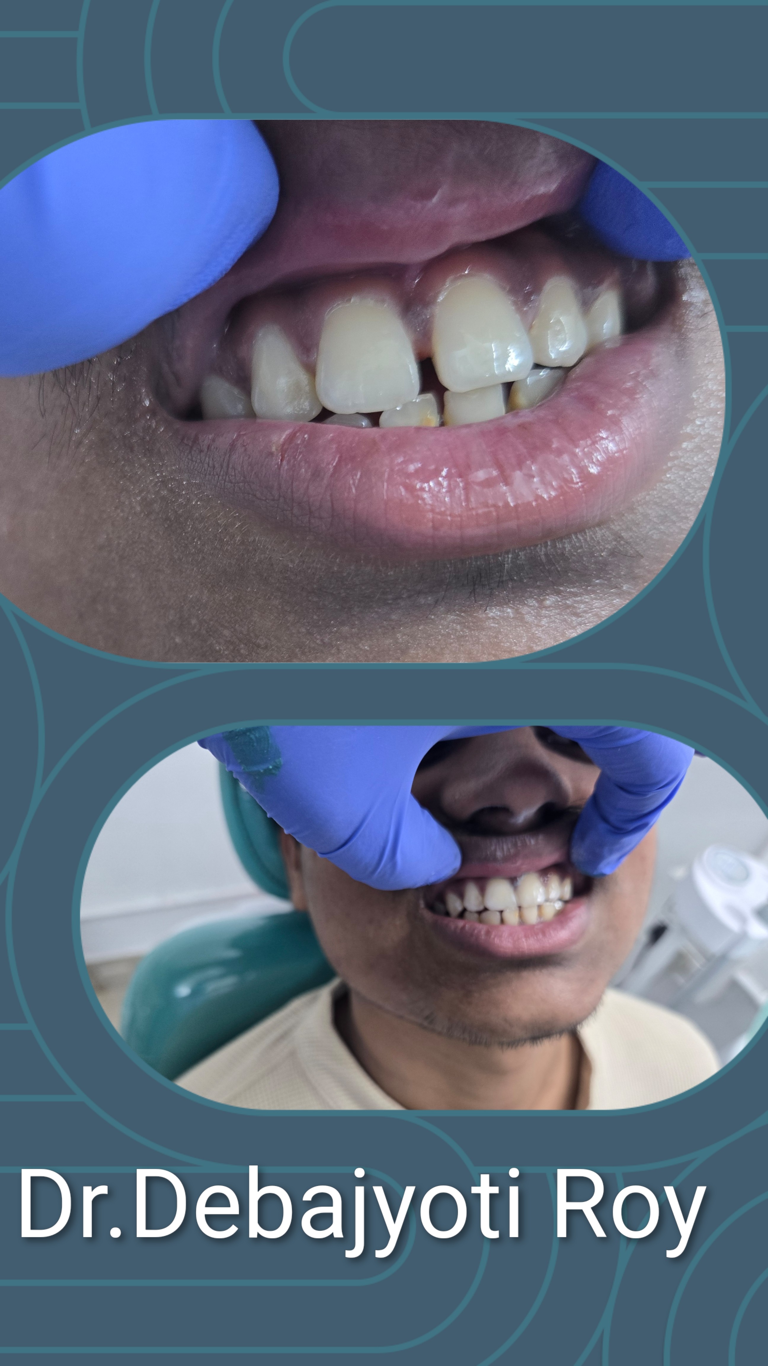 Midline Diastema Closure Case