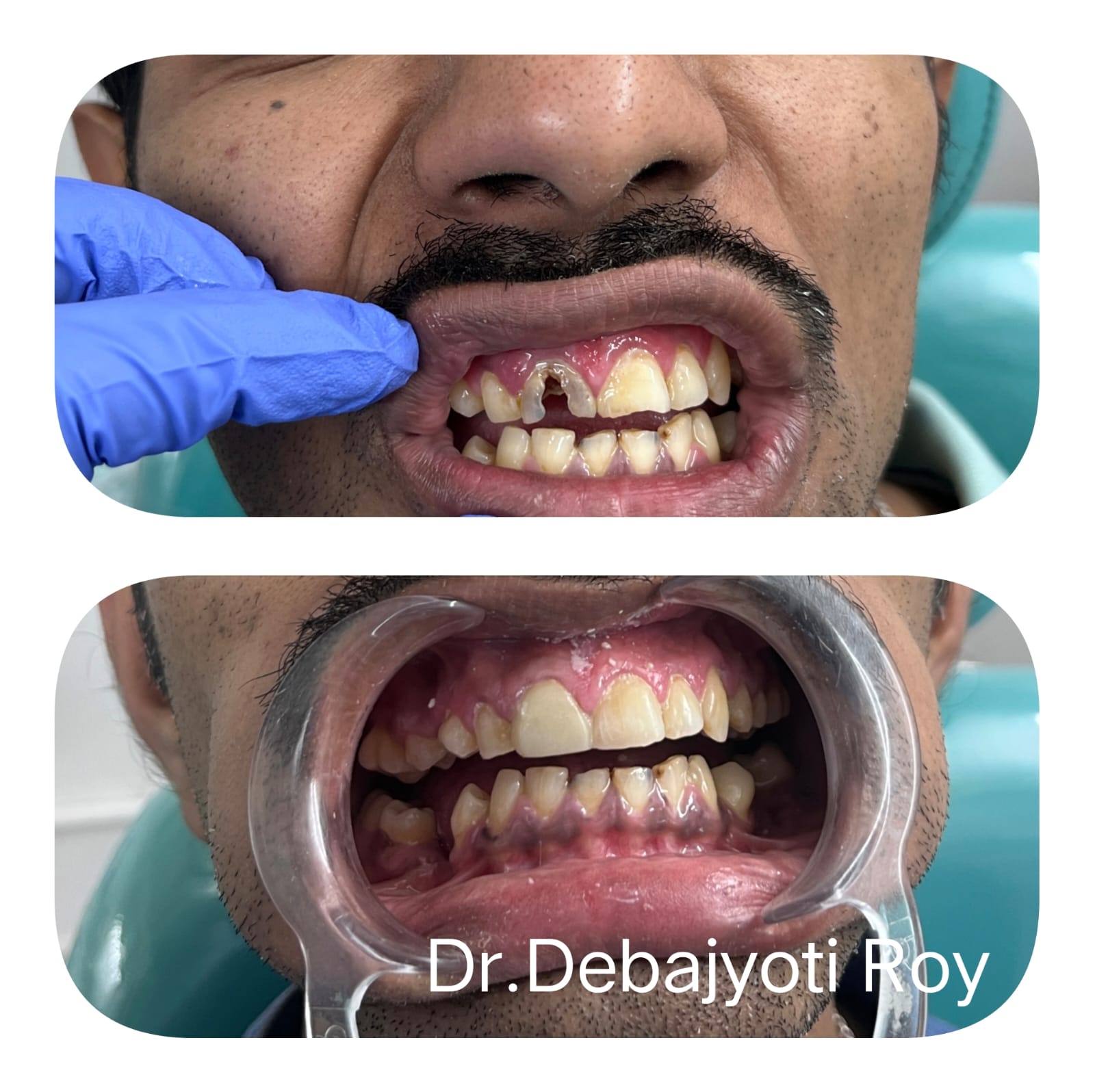 Anterior Fractured Tooth Reconstruction
