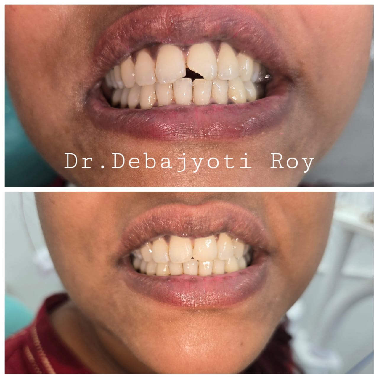 Anterior Fractured Crown Reconstruction