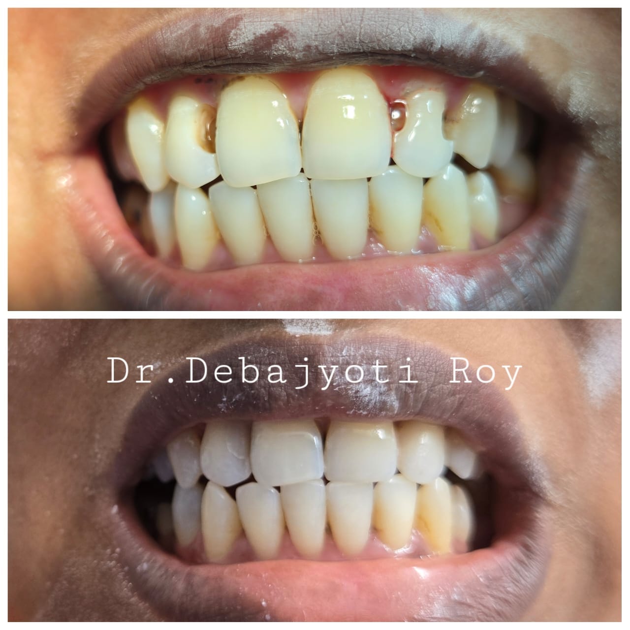 Cervical Lesion Aesthetic Correction